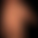 Skleromyxödem bei Paraproteinämie:&nbsp;wachsartige Sklerose der Handflächen.
