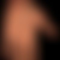 Skleromyxödem bei Paraproteinämie:&nbsp;wachsartige Sklerose der Handflächen.
