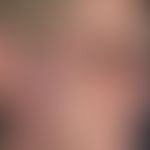 Xanthogranulom, nekrobiotisches mit Paraproteinämie. Bei der 62-jährigen Patientin zeigen sich me...