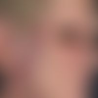 Xanthogranulom, nekrobiotisches mit Paraproteinämie. Bei der 62-jährigen Patientin zeigen sich me...