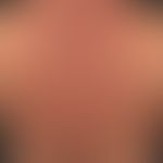 Scleroedema adultorum:&nbsp;seit &nbsp;mehreren Jahren bestehende, mit zunehmender Steifigkeit ei...