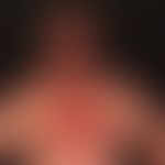 Nebenwirkungen von&nbsp;Vemurafenib:&nbsp;photoallergische Dermatitis unter Vemurafenib-Therapie.
