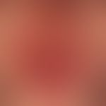 Nebenwirkungen von&nbsp;Vemurafenib:&nbsp;photoallergische Dermatitis unter Vemurafenib-Therapie ...
