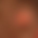 Naevus sebaceus:&nbsp;Seit Geburt bestehende, haarlose, völlig symptomlose, zunächst glatte, post...