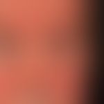 Lidödem: unregelmäßig auftrende Schwellung des Lides. Bekannte Rosacea erythematosa.&nbsp;&nbsp;
