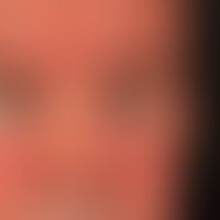 Lidödem: unregelmäßig auftrende Schwellung des Lides. Bekannte Rosacea erythematosa.&nbsp;&nbsp;
