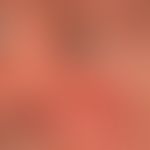 Lidödem: unregelmäßig auftrende Schwellung des Lides. Bekannte Rosacea erythematosa.&nbsp;&nbsp;
