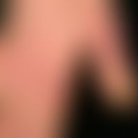 Chilblain-Lupus:&nbsp;flächige, mäßig&nbsp;schmerzhafte, leicht keratotische&nbsp;Plaques an den ...