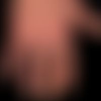 Chilblain-Lupus:&nbsp;flächige, mäßig&nbsp;schmerzhafte, keratotische&nbsp;Plaques an den Akren.&...