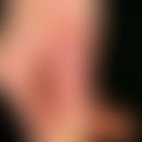 Chilblain-Lupus:&nbsp;flächige, schmerzhafte, keratotische&nbsp;Plaques an den Akren.&nbsp;
