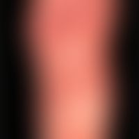 Erysipel:&nbsp;flächige Rötung und Schwellung des linken &nbsp;Fußes bei einem 57-jährigen Mann. ...