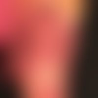 Psoriasis palmaris et plantaris:&nbsp;rote Plaques mit Rhagaden und groblamellärer Schuppung auf ...
