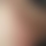 Erythrasma: Mann, 86 Jahre. Beim Hautcheck nebenbefundlich auffälliges randscharfes Erythem mit z...