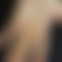 Hand-Fuß-Mund-Krankheit: Junge, 10 Jahre. Befund seit 2 Tagen rasch aufgeschossen. Befall Handflä...