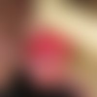 Mann, 83 J. Subj komplett symptomlos. Nebenbefund im Rahmen des Hautkrebsscreenings.
