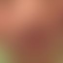 Immundefizienz 58: chronische aktinische Dermatitis. Abb. entnommen aus: Shayegan LH et al. (2020)
