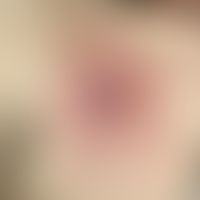 Ekthyma gangraenosum: hochschmerzhaftes initial furunkuloides Infiltrat mit massiver kollateraler...