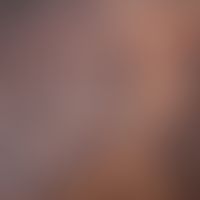 Pityriasis rotunda:&nbsp;Detailaufnahme der Randzone.&nbsp; Abb. entommen aus&nbsp;Pinos-Leóna L ...