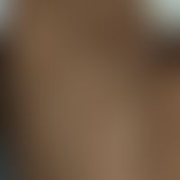 Hypomelanose progressive makulöse: multiple, unscharf begrenzte verwaschene grau-weißliche Flecke...