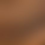 Pityriasis rotunda: Aphlegmasischer, ideal rundes, scharf demarkiertes Areal mit knittriger,&nbsp...