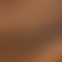 Pityriasis rotunda: Aphlegmasischer, ideal rundes, scharf demarkiertes Areal mit knittriger,&nbsp...