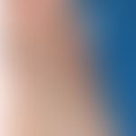 Nonbakterielle&nbsp;Osteomyelitis der Sternocostoclavicular Region. Schmerzhafte Schwellung.Abb. ...