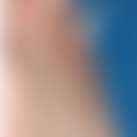 Nonbakterielle&nbsp;Osteomyelitis der Sternocostoclavicular Region. Schmerzhafte Schwellung.Abb. ...