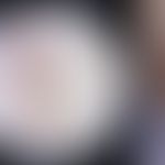Basalzellkarzinom, pigmentiertes (Auflichtmikroskopie): Frau, 67J. Zufallsbefund im Rahmen eines ...