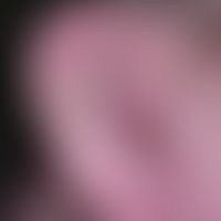 Amikrobielle intertriginöse Pustulose:&nbsp;Pustulöse Dermatitis der Ohrrgeion. Abb. entnommen au...