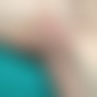 Amikrobielle intertriginöse Pustulose: pustulöse&nbsp;Dermatitis axillär (Befund der Hiradenitis ...