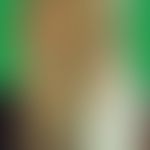 Keratosis follicularis spinulosa decalvans: plaqueförmige Palmo-Plantakeratose. Abb. entnommen au...