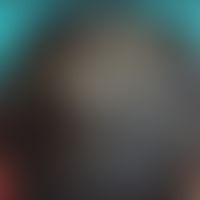 Keratosis follicularis spinulosa decalvans: Alopezie mit multiplen follikulären, nicht entzündlic...