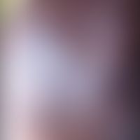 Keratosis follicularis spinulosa decalvans: Alopezie mit multiplen follikulären, nicht entzündlic...