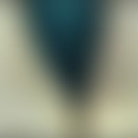 Keratosis follicularis spinulosa decalvans: Alopezie mit multiplen follikulären, nicht entzündlic...
