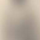 Syphilid, tubero-serpiginöses (historische Aufnahme): Ausgedehntes Krankheitsbild. Abb. entnommen...