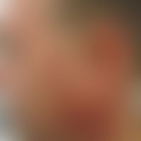 Erythromelanosis follicularis faciei et colli: flächige Pigmentierungen und ortstreue Erytheme du...