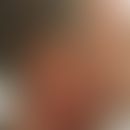 Erythromelanosis follicularis faciei et colli: flächige Pigmentierungen und fixierte Erytheme dur...
