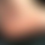 Porokeratotischer ekkriner Ostiumnaevus: bizarr konfigurierte Ansammlungen von warzenförmgen kera...