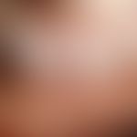 Porokeratotischer ekkriner Ostiumnaevus: bizarr konfigurierte Ansammlungen von warzenförmgein ker...