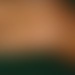 Porokeratotischer ekkriner Ostiumnaevus: bizarr konfigurierte Ansammlungen von keratotischen Pape...