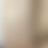 Nilotinib: erworbene Keratosi pilaris unter Theapie mit&nbsp;Nilotinib. Abb. entnommen aus:&nbsp;...