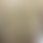 Nilotinib: erworbene Keratosi pilaris unter Theapie mit&nbsp;Nilotinib. Abb. entnommen aus:&nbsp;...