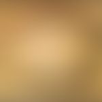 Nilotinib: erworbene Ulerythema ophryogenes&nbsp;unter Therapie mit&nbsp;Nilotinib. Abb. entnomme...