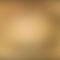Nilotinib: erworbene Ulerythema ophryogenes&nbsp;unter Therapie mit&nbsp;Nilotinib. Abb. entnomme...