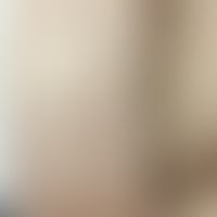 Keratosis pilaris (erworben) unter einer Therapie mit&nbsp;Nilotinib. Abb. entnommen aus: Leong W...