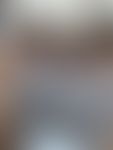 Affenpocken: Schmerzhafte Erosionen und Ulzera im Genitalbereich. Patient hatte hier Zinksalbe ap...