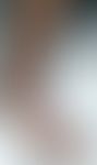 Affenpocken: Multiple Papeln&nbsp;und Pusteln,&nbsp;zum Teil&nbsp;in Plaques&nbsp;konfluierend am...