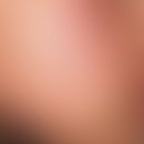 Keratosis pilaris atrophicans faciei: flächige Wangenrötung. Weiß eingekreist zahlreiche follikul...