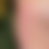 Erythema palmoplantare hereditarium : seit Geburt bestehendes völlig sympotmloses Erythem. Abbild...