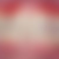 Chronische ulzerative Stomatitis: Chronische therapieresistente erosive Mukositis. Abb entnommen ...